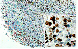 Cervical Squamous Cell Carcinoma: Ki-67 — Anti-Mouse HRP